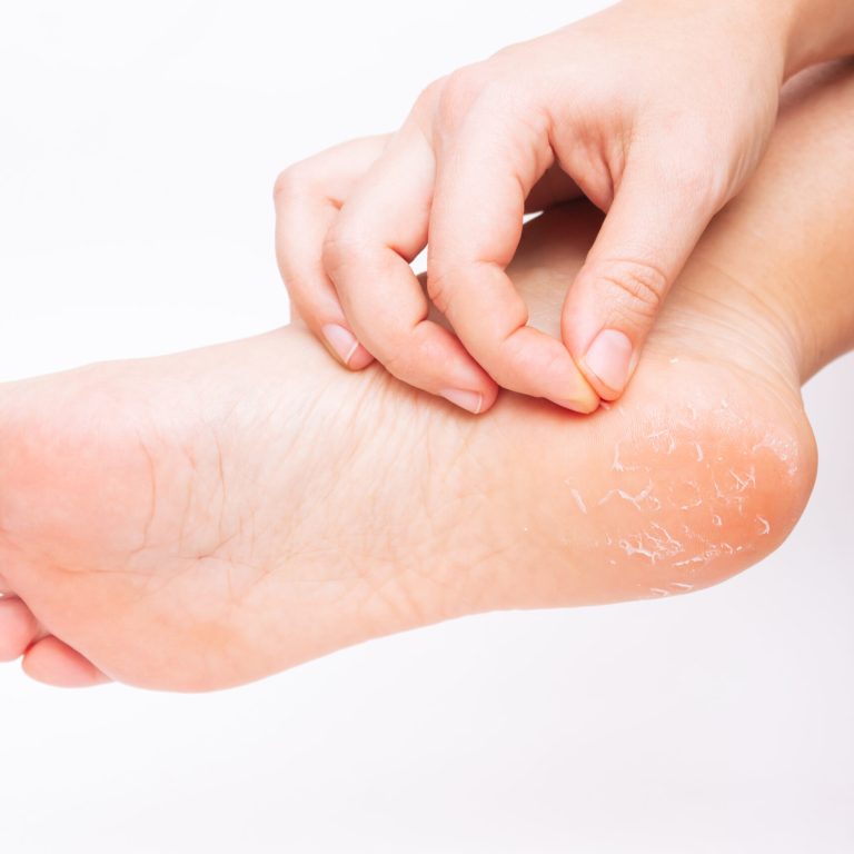 closeup-womans-foot-with-peeling-skin-heel-young-woman-scrubs-foot-allergies-eczema